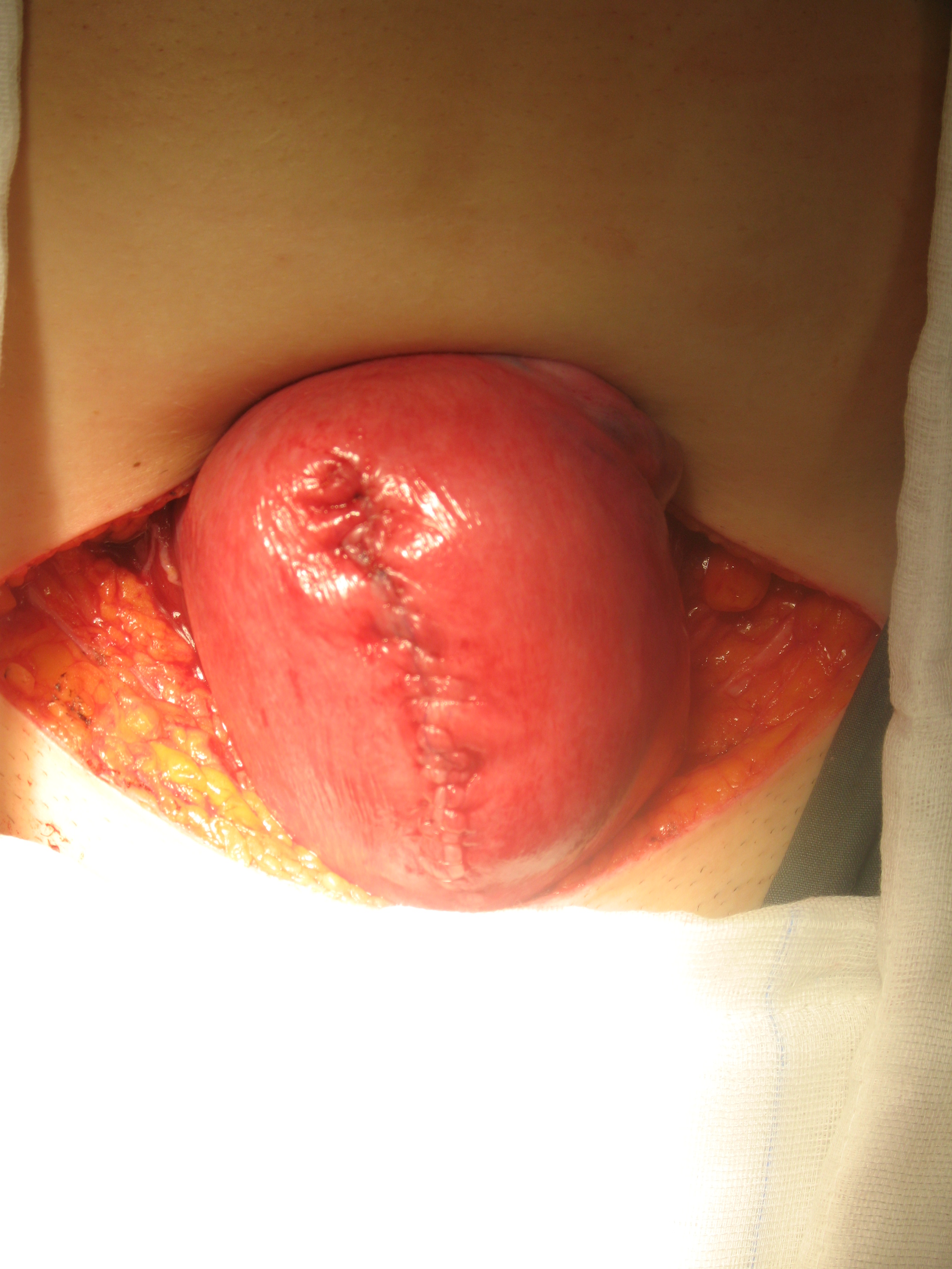 using fibroid scew 11cm fibroid myoma suturing the uterus to restore ...