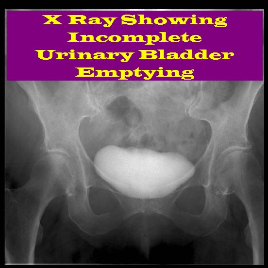Natural Remedies for Bladder Control Incomplete%20Bladder%20Emptying Natural Remedies for Bladder Control